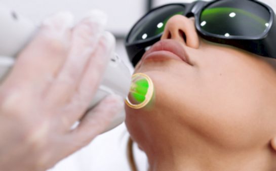 Лазерная эпиляция подбородка