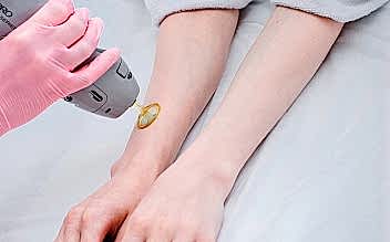 Лазерная эпиляция рук (полностью)