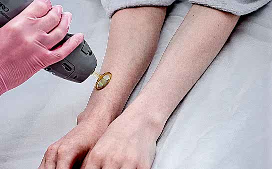 Лазерная эпиляция рук (полностью)