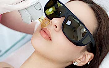 Лазерная эпиляция лица полностью