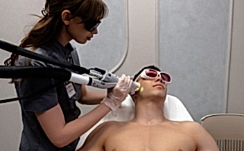 Лазерная эпиляция бороды для мужчин