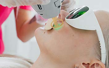 Лазерная эпиляция щёк