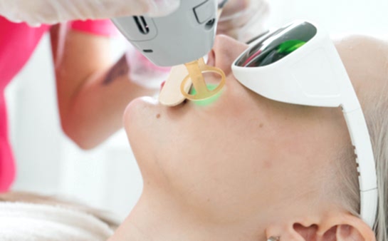 Лазерная эпиляция щёк