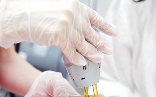 Лазерная эпиляция рук (до локтя)