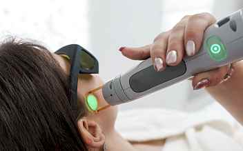 Лазерная эпиляция бакенбард