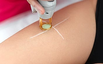 Лазерная эпиляция бёдер