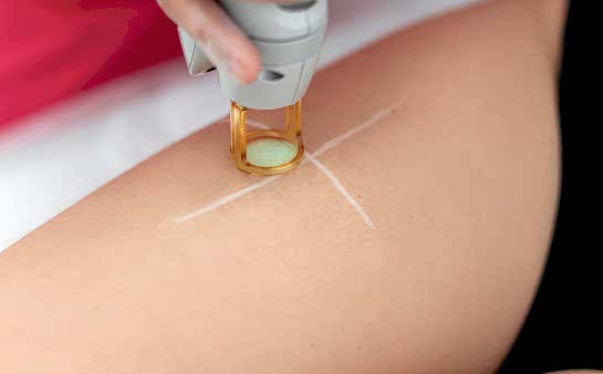 Лазерная эпиляция бёдер