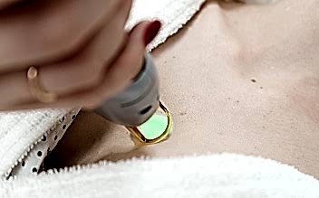 Лазерная эпиляция зоны декольте