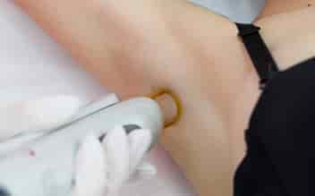 Лазерная эпиляция подмышек