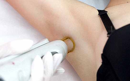 Лазерная эпиляция подмышек