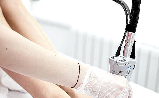 Лазерная эпиляция голени