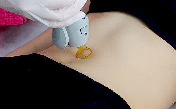 Лазерная эпиляция кожи живота